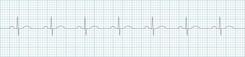 ECG-Normal-sinus-rhythm-strip